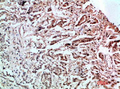 Immunohistochemical analysis of paraffin-embedded human-stomach-cancer, antibody was diluted at 1:200Rabbit anti-Human L1CAM Polyclonal Antibody