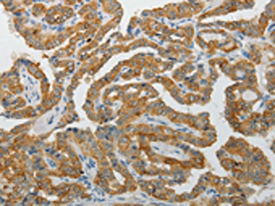 The image on the left is immunohistochemistry of paraffin-embedded Human thyroid cancer tissue using PADI4 Antibody(PADI4 Antibody) at dilution 1/25, on the right is treated with fusion protein. (Original magnification: ×200)Rabbit anti-Human PADI4 Polyclonal Antibody