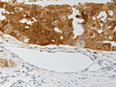 The image on the left is immunohistochemistry of paraffin-embedded Human breast cancer tissue using the antibody Antibody) at dilution 1/25, on the right is treated with fusion protein. (Original magnification: ×200)Rabbit anti-Human PADI4 Polyclonal Antibody