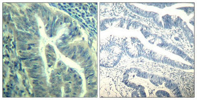 Immunohistochemical analysis of paraffin-embedded human colon carcinoma tissue using CDK6(Phospho-Tyr24) Antibody(left) or the same antibody preincubated with blocking peptide(right).Rabbit anti-Human CDK6 Polyclonal Antibody