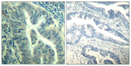 Immunohistochemical analysis of paraffin-embedded human colon carcinoma tissue using CDK6(Phospho-Tyr24) Antibody(left) or the same antibody preincubated with blocking peptide(right).Rabbit anti-Human CDK6 Polyclonal Antibody