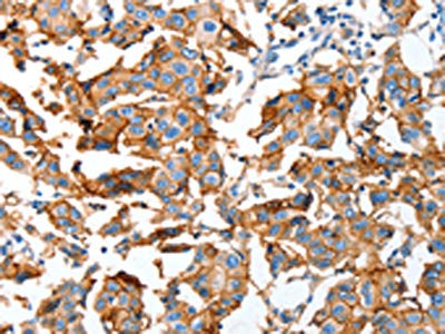 The image on the left is immunohistochemistry of paraffin-embedded Human breast cancer tissue using AOX1 Antibody(AOX1 Antibody) at dilution 1/65, on the right is treated with fusion protein. (Original magnification: ×200)Rabbit anti-Human AOX1 Polyclonal Antibody