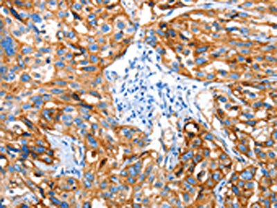 The image on the left is immunohistochemistry of paraffin-embedded Human esophagus cancer tissue using the antibody Antibody) at dilution 1/65, on the right is treated with fusion protein. (Original magnification: ×200)Rabbit anti-Human AOX1 Polyclonal Antibody