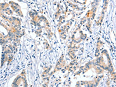 The image on the left is immunohistochemistry of paraffin-embedded Human colon cancer tissue using ALPP Antibody(ALPP Antibody) at dilution 1/50, on the right is treated with fusion protein. (Original magnification: ×200)Rabbit anti-Human ALPP Polyclonal Antibody
