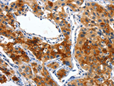 The image on the left is immunohistochemistry of paraffin-embedded Human lung cancer tissue using the antibody Antibody) at dilution 1/50, on the right is treated with fusion protein. (Original magnification: ×200)Rabbit anti-Human ALPP Polyclonal Antibody