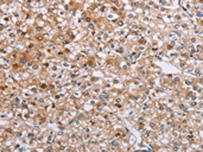The image on the left is immunohistochemistry of paraffin-embedded Human prostate cancer tissue using ETFB Antibody(ETFB Antibody) at dilution 1/50, on the right is treated with synthetic peptide. (Original magnification: ×200)Rabbit anti-Human ETFB Polyclonal Antibody