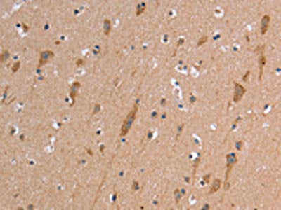The image on the left is immunohistochemistry of paraffin-embedded Human brain tissue using the antibody Antibody) at dilution 1/50, on the right is treated with synthetic peptide. (Original magnification: ×200)Rabbit anti-Human ETFB Polyclonal Antibody