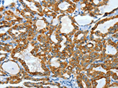 The image on the left is immunohistochemistry of paraffin-embedded Human thyroid cancer tissue using KRT40 Antibody(KRT40 Antibody) at dilution 1/50, on the right is treated with fusion protein. (Original magnification: X200)