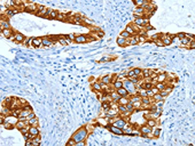 The image on the left is immunohistochemistry of paraffin-embedded Human cervical cancer tissue using the antibody Antibody) at dilution 1/50, on the right is treated with fusion protein. (Original magnification: X200)
