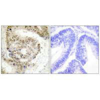 Immunohistochemistry analysis of paraffin-embedded human colon carcinoma tissue using hnRNP L antibody.Rabbit anti-Human HNRNPL Polyclonal Antibody