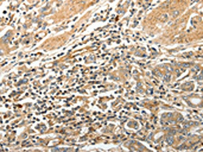 The image on the left is immunohistochemistry of paraffin-embedded Human gastric cancer tissue using STX1A Antibody(STX1A Antibody) at dilution 1/20, on the right is treated with synthetic peptide. (Original magnification: ×200)Rabbit anti-Human STX1A Polyclonal Antibody