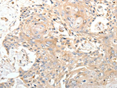 The image on the left is immunohistochemistry of paraffin-embedded Human esophagus cancer tissue using the antibody Antibody) at dilution 1/20, on the right is treated with synthetic peptide. (Original magnification: ×200)Rabbit anti-Human STX1A Polyclonal Antibody