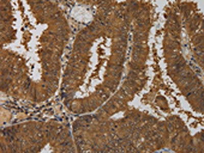 The image on the left is immunohistochemistry of paraffin-embedded Human colon cancer tissue using the antibody Antibody) at dilution 1/50, on the right is treated with fusion protein. (Original magnification: ×200)Rabbit anti-Human TAB1 Polyclonal Antibody