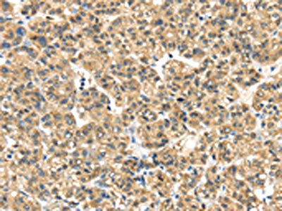 The image on the left is immunohistochemistry of paraffin-embedded Human thyroid cancer tissue using the antibody Antibody) at dilution 1/35, on the right is treated with synthetic peptide. (Original magnification: ×200)