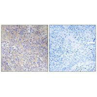 Immunohistochemistry analysis of paraffin-embedded human cervix carcinoma tissue using MRPL11 antibody.Rabbit anti-Human MRPL11 Polyclonal Antibody