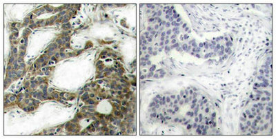 Immunohistochemical analysis of paraffin-embedded human breast carcinoma tissue using b-Catenin(Ab-33) Antibody(left) or the same antibody preincubated with blocking peptide(right).Rabbit anti-Human CTNNB1 Polyclonal Antibody