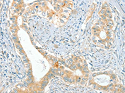 The image on the left is immunohistochemistry of paraffin-embedded Human cervical cancer tissue using the antibody Antibody) at dilution 1/80, on the right is treated with synthetic peptide. (Original magnification: ×200)