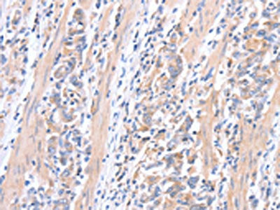 The image on the left is immunohistochemistry of paraffin-embedded Human gastic cancer tissue using ACTR3B Antibody(ACTR3B Antibody) at dilution 1/15, on the right is treated with fusion protein. (Original magnification: ×200)
