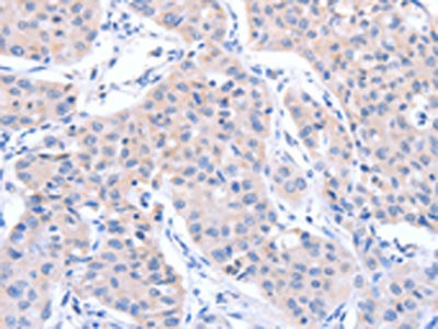 The image on the left is immunohistochemistry of paraffin-embedded Human lung cancer tissue using the antibody Antibody) at dilution 1/15, on the right is treated with fusion protein. (Original magnification: ×200)