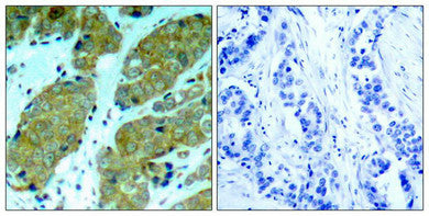 Immunohistochemical analysis of paraffin-embedded human breast carcinoma tissue using mTOR(Phospho-Ser2448) Antibody(left) or the same antibody preincubated with blocking peptide(right).Rabbit anti-Human MTOR Polyclonal Antibody