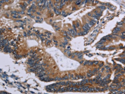 The image on the left is immunohistochemistry of paraffin-embedded Human colon cancer tissue using the antibody Antibody) at dilution 1/50, on the right is treated with fusion protein. (Original magnification: ×200)Rabbit anti-Human CLDND1 Polyclonal Antibody