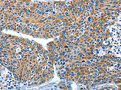 The image on the left is immunohistochemistry of paraffin-embedded Human liver cancer tissue using ALDH3B1 Antibody(ALDH3B1 Antibody) at dilution 1/20, on the right is treated with fusion protein. (Original magnification: ×200)Rabbit anti-Human ALDH3B1 Polyclonal Antibody