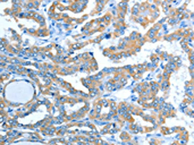 The image on the left is immunohistochemistry of paraffin-embedded Human thyroid cancer tissue using the antibody Antibody) at dilution 1/20, on the right is treated with fusion protein. (Original magnification: ×200)Rabbit anti-Human ALDH3B1 Polyclonal Antibody