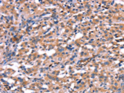 The image on the left is immunohistochemistry of paraffin-embedded Human thyroid cancer tissue using HMGCS1 Antibody(HMGCS1 Antibody) at dilution 1/40, on the right is treated with synthetic peptide. (Original magnification: ×200)Rabbit anti-Human HMGCS1 Polyclonal Antibody