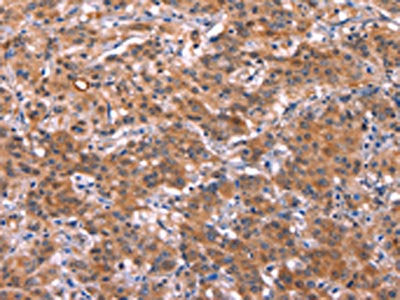 The image on the left is immunohistochemistry of paraffin-embedded Human gastic cancer tissue using the antibody Antibody) at dilution 1/40, on the right is treated with synthetic peptide. (Original magnification: ×200)Rabbit anti-Human HMGCS1 Polyclonal Antibody