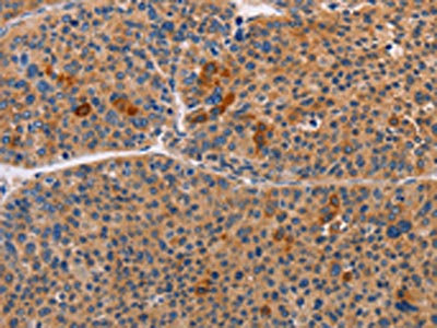 The image on the left is immunohistochemistry of paraffin-embedded Human liver cancer tissue using ALDH3A1 Antibody(ALDH3A1 Antibody) at dilution 1/55, on the right is treated with fusion protein. (Original magnification: ×200)Rabbit anti-Human ALDH3A1 Polyclonal Antibody