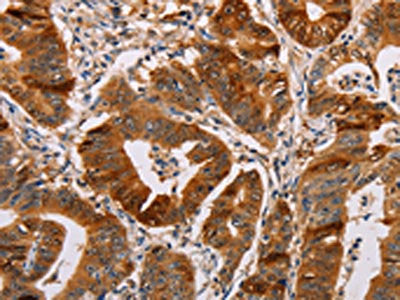 The image on the left is immunohistochemistry of paraffin-embedded Human gastic cancer tissue using the antibody Antibody) at dilution 1/55, on the right is treated with fusion protein. (Original magnification: ×200)Rabbit anti-Human ALDH3A1 Polyclonal Antibody