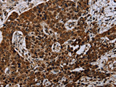 The image on the left is immunohistochemistry of paraffin-embedded Human liver cancer tissue using NDUFA4 Antibody(NDUFA4 Antibody) at dilution 1/40, on the right is treated with synthetic peptide. (Original magnification: ×200)Rabbit anti-Human NDUFA4 Polyclonal Antibody