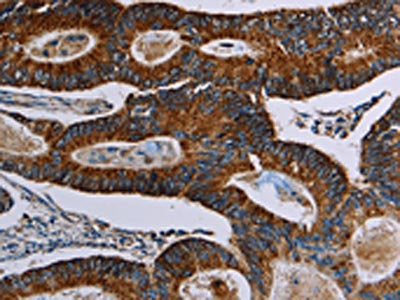 The image on the left is immunohistochemistry of paraffin-embedded Human colon cancer tissue using the antibody Antibody) at dilution 1/40, on the right is treated with synthetic peptide. (Original magnification: ×200)Rabbit anti-Human NDUFA4 Polyclonal Antibody