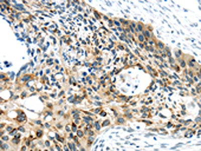 The image on the left is immunohistochemistry of paraffin-embedded Human esophagus cancer tissue using VAMP2 Antibody(VAMP2 Antibody) at dilution 1/40, on the right is treated with synthetic peptide. (Original magnification: ×200)Rabbit anti-Human VAMP2 Polyclonal Antibody