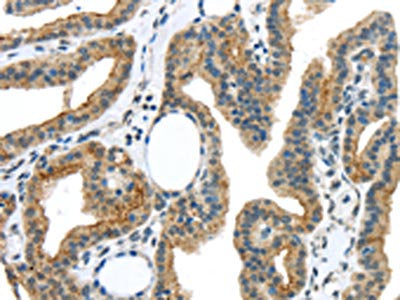The image on the left is immunohistochemistry of paraffin-embedded Human thyroid cancer tissue using the antibody Antibody) at dilution 1/40, on the right is treated with synthetic peptide. (Original magnification: ×200)Rabbit anti-Human VAMP2 Polyclonal Antibody