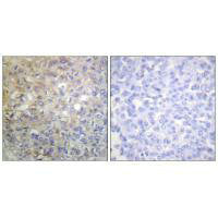 Immunohistochemistry analysis of paraffin-embedded human breast carcinoma tissue using FGFR1 (Ab-766) antiobdy.Rabbit anti-Human FGFR1 Polyclonal Antibody