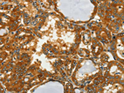 The image on the left is immunohistochemistry of paraffin-embedded Human thyroid cancer tissue using the antibody Antibody) at dilution 1/50, on the right is treated with fusion protein. (Original magnification: ×200)Rabbit anti-Human GOT1 Polyclonal Antibody