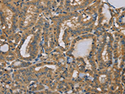 The image on the left is immunohistochemistry of paraffin-embedded Human thyroid cancer tissue using the antibody Antibody) at dilution 1/40, on the right is treated with fusion protein. (Original magnification: ×200)Rabbit anti-Human MYL3 Polyclonal Antibody