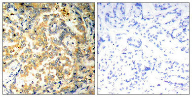 Immunohistochemical analysis of paraffin-embedded human lung carcinoma tissue using NFkB-p100/p52(Ab-872) Antibody(left) or the same antibody preincubated with blocking peptide(right).Rabbit anti-Human NFKB2 Polyclonal Antibody