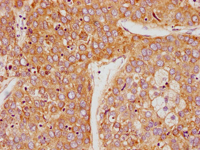 IHC image of the antibody diluted at 1:100 and staining in paraffin-embedded human liver cancer performed on a Leica BondTM system. After dewaxing and hydration, antigen retrieval was mediated by high pressure in a citrate buffer (pH 6.0). Section was blocked with 10% normal goat serum 30min at RT. Then primary antibody (1% BSA) was incubated at 4°C overnight. The primary is detected by a biotinylated secondary antibody and visualized using an HRP conjugated SP system.Rabbit anti-Human PSG9 Polyclonal Antibody