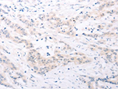 The image on the left is immunohistochemistry of paraffin-embedded Human colon cancer tissue using SPATA16 Antibody(SPATA16 Antibody) at dilution 1/25, on the right is treated with fusion protein. (Original magnification: ×200)Rabbit anti-Human SPATA16 Polyclonal Antibody