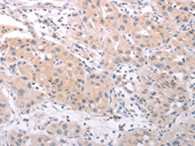 The image on the left is immunohistochemistry of paraffin-embedded Human lung cancer tissue using the antibody Antibody) at dilution 1/25, on the right is treated with fusion protein. (Original magnification: ×200)Rabbit anti-Human SPATA16 Polyclonal Antibody