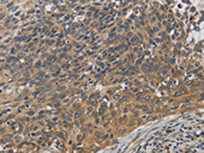 The image on the left is immunohistochemistry of paraffin-embedded Human cervical cancer tissue using EMC8 Antibody(EMC8 Antibody) at dilution 1/30, on the right is treated with fusion protein. (Original magnification: ×200)Rabbit anti-Human EMC8 Polyclonal Antibody