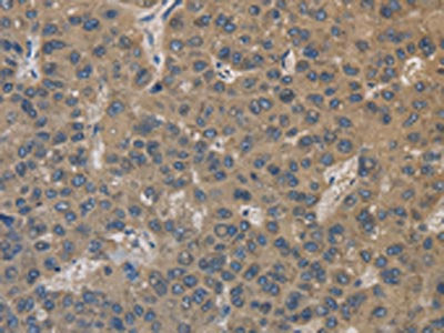 The image on the left is immunohistochemistry of paraffin-embedded Human liver cancer tissue using the antibody Antibody) at dilution 1/30, on the right is treated with fusion protein. (Original magnification: ×200)Rabbit anti-Human EMC8 Polyclonal Antibody