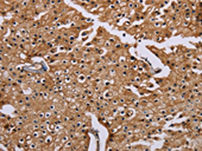 The image on the left is immunohistochemistry of paraffin-embedded Human prostate cancer tissue using the antibody Antibody) at dilution 1/20, on the right is treated with synthetic peptide. (Original magnification: ×200)Rabbit anti-Human CSNK1A1 Polyclonal Antibody