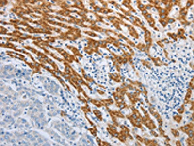 The image on the left is immunohistochemistry of paraffin-embedded Human liver cancer tissue using SLC5A5 Antibody(SLC5A5 Antibody) at dilution 1/30, on the right is treated with synthetic peptide. (Original magnification: ×200)Rabbit anti-Human SLC5A5 Polyclonal Antibody