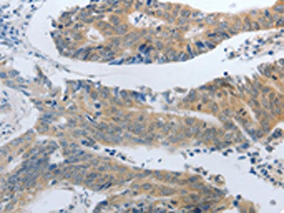 The image on the left is immunohistochemistry of paraffin-embedded Human colon cancer tissue using the antibody Antibody) at dilution 1/30, on the right is treated with synthetic peptide. (Original magnification: ×200)Rabbit anti-Human SLC5A5 Polyclonal Antibody