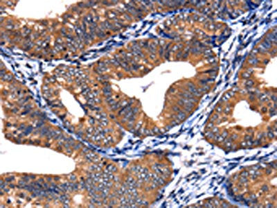 The image on the left is immunohistochemistry of paraffin-embedded Human cervical cancer tissue using CSNK2A1 Antibody(CSNK2A1 Antibody) at dilution 1/13, on the right is treated with fusion protein. (Original magnification: ×200)Rabbit anti-Human CSNK2A1 Polyclonal Antibody