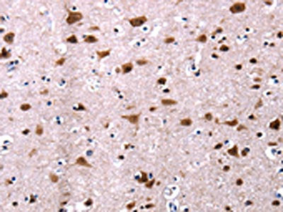 The image on the left is immunohistochemistry of paraffin-embedded Human brain tissue using the antibody Antibody) at dilution 1/13, on the right is treated with fusion protein. (Original magnification: ×200)Rabbit anti-Human CSNK2A1 Polyclonal Antibody