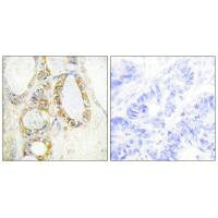 Immunohistochemistry analysis of paraffin-embedded human colon carcinoma tissue using MUC13 antibody.Rabbit anti-Human MUC13 Polyclonal Antibody